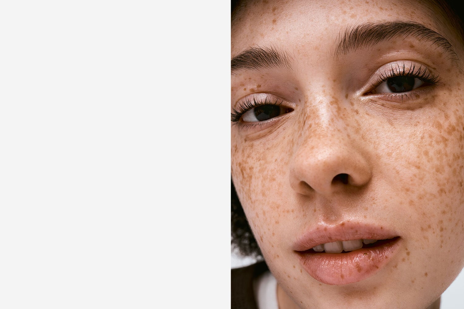 Acne-prone skin